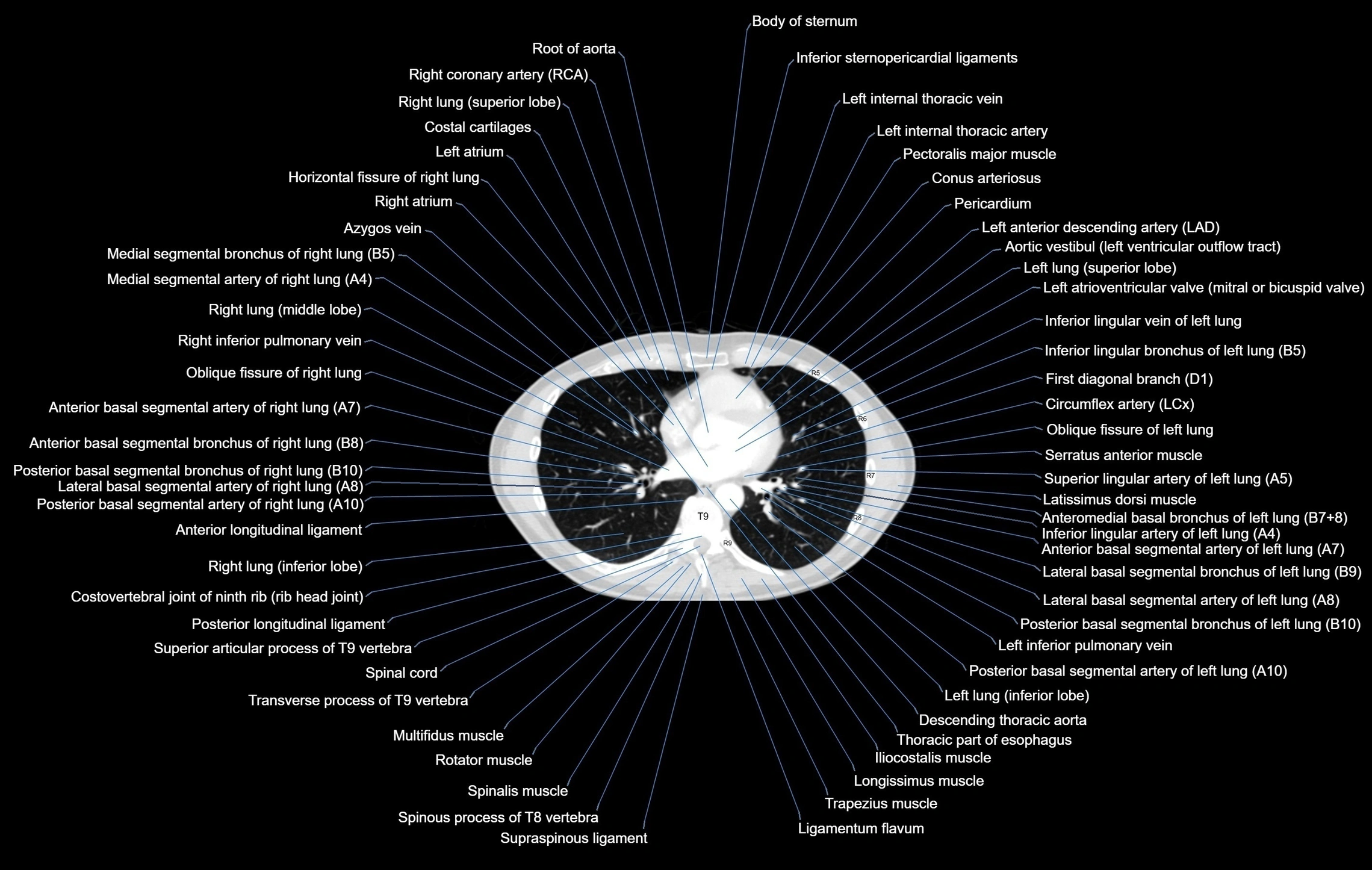 CT chest (thorax) labelled axial cross sectional anatomy radiology image-00073.webp